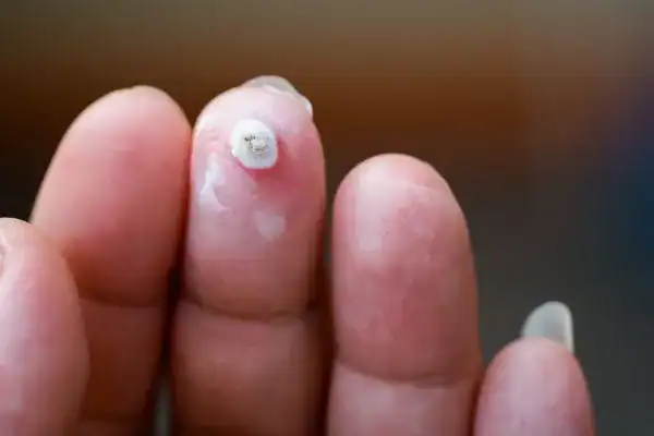 Image of white wart before cryopen treatment Didcot