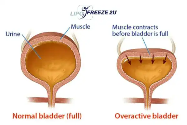 diagram of overactive bladder treatment Didcot