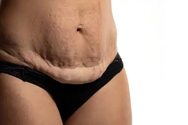 loose skin after weight loss injections Didcot