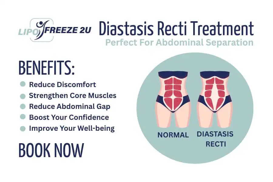 Benefits of body toning treatment Didcot for Diastasis recti
