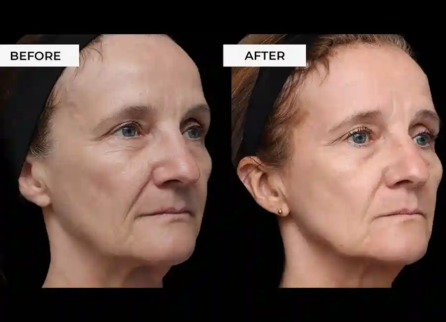 How Many RF Microneedling Sessions Will You Need to See a Difference Didcot?