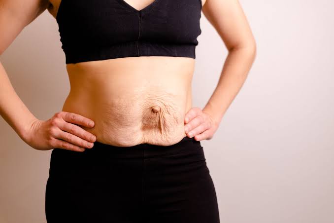 Is Surgery Really the Only Way to Repair Diastasis Recti Didcot?