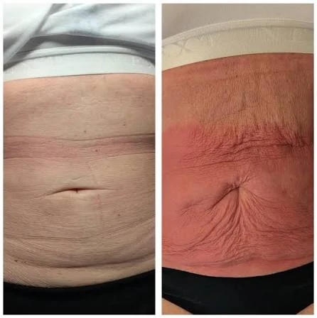 How Does RF Microneedling Improve Crepey, Thin and Uneven Skin Texture Didcot?