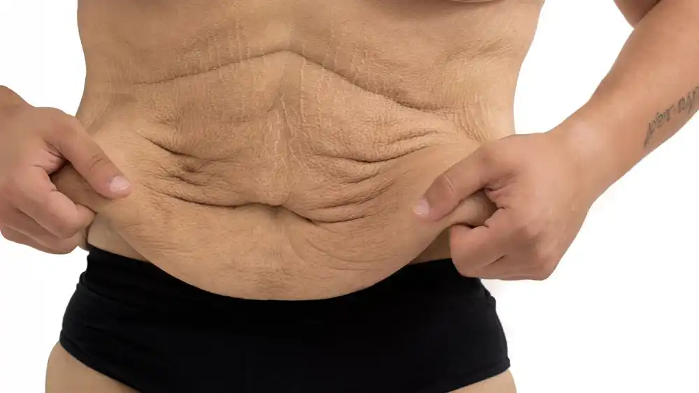Why Does Weight Loss Medication Leave Some People With Loose or Sagging Skin Didcot?